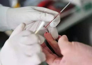 白血病的治療有哪些方法治療