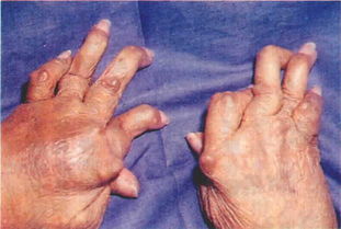 內(nèi)風(fēng)濕有哪些癥狀及治療方法