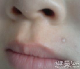 點痣后怎么修復(fù)最好方法有哪些