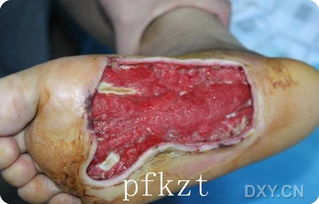 創(chuàng)面修復的方法主要有哪些