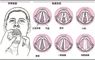 聲帶小結(jié)手術需不需要住院(需不需要作文)