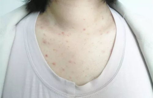 疥瘡,注意事項(xiàng),毛囊炎