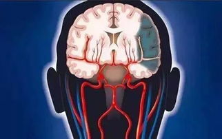 腦血栓后室外冷注意事項(xiàng)