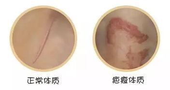 注意事項(xiàng),去疤