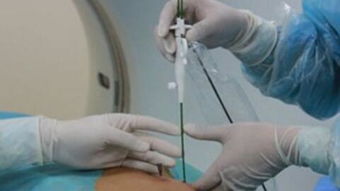 導(dǎo)管,消融,術(shù)后,注意事項