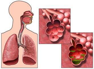 肺氣腫應(yīng)注意事項(xiàng)