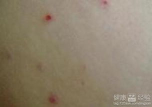 疹子,注意事項,寶寶