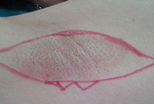 腳趾手術(shù)拆線(xiàn)后注意事項(xiàng)