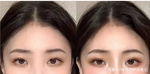 眉骨開裂注意事項(xiàng)