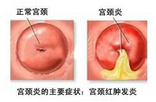 宮頸息肉要注意事項