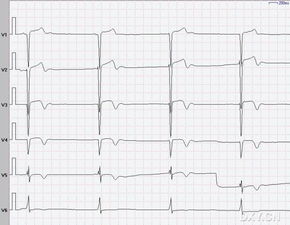 心電圖測量時注意事項