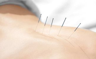 針灸,注意事項