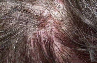 紅結(jié)炎注意事項