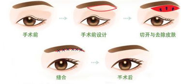 兒童上瞼下垂手術后注意事項