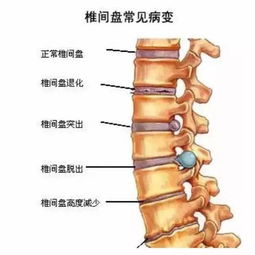 腰椎間盤小關(guān)節(jié)綜合癥注意事項