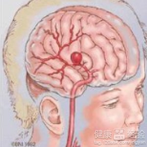 腦動脈瘤夾閉術后10年,腦動脈瘤夾閉術后三個月,腦動脈瘤術后飲食注意事項