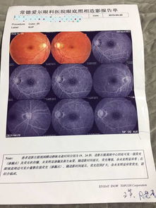 眼科造影注意事項