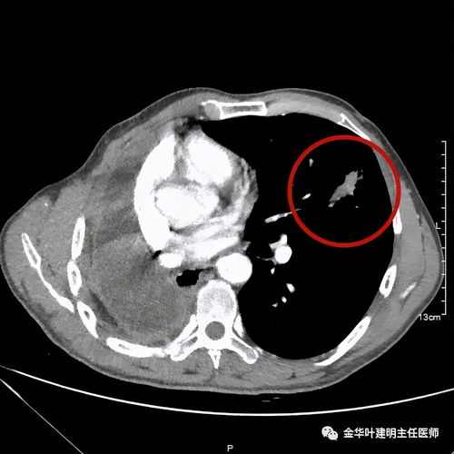 做完pet-ct之后注意事項(xiàng)