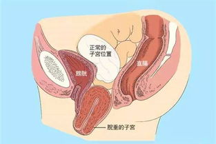 做子宮脫垂修補(bǔ)術(shù)后注意事項(xiàng)