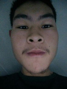 臉部祛痣后注意事項,臉部手術(shù)切痣后注意事項,取了痣的注意事項