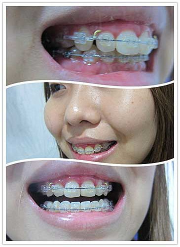 補(bǔ)牙牙套后注意事項