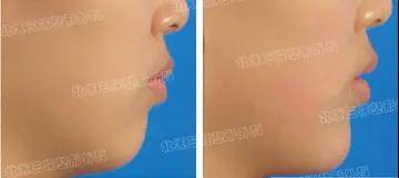 隆下頦后注意事項(xiàng)藝星