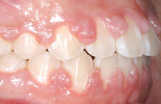 補(bǔ)牙戴牙套后注意事項,補(bǔ)牙后裝牙套后有什么注意事項,補(bǔ)牙后的注意事項