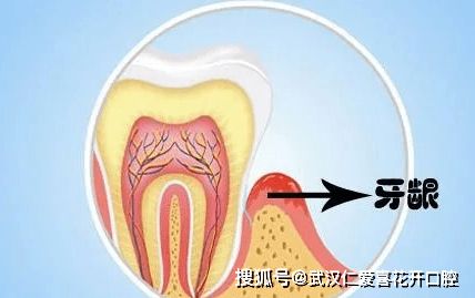 牙槽骨修整術(shù)的注意事項,牙及牙槽骨損傷結(jié)扎注意事項,牙槽骨釘注意事項