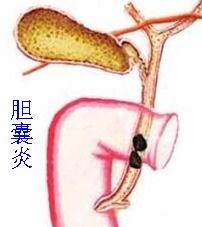 女人膽結(jié)石注意事項
