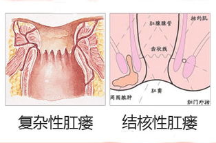 內(nèi)瘺的術(shù)后護(hù)理及注意事項(xiàng),動(dòng)靜脈內(nèi)瘺的護(hù)理與注意事項(xiàng),肛瘺術(shù)后護(hù)理注意事項(xiàng)