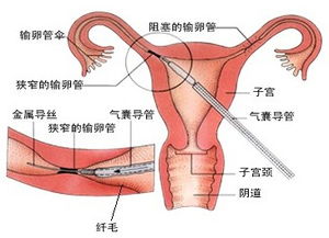 結(jié)扎復(fù)通術(shù)后注意事項