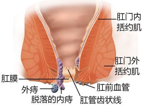 痔瘡肛瘺術(shù)前術(shù)后注意事項(xiàng)
