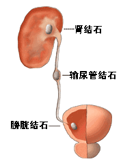 尿路結(jié)石術(shù)后注意事項(xiàng)有哪些,尿路結(jié)石插管術(shù)后注意事項(xiàng),尿路結(jié)石微創(chuàng)手術(shù)后注意事項(xiàng)