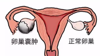 左側(cè)卵巢囊腫注意事項