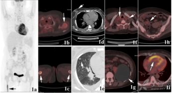 做完,注意事項(xiàng),pet,ct