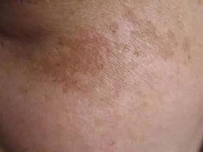 長痘痘洗臉怎么注意事項