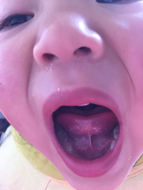 舌細(xì)帶手術(shù)注意事項(xiàng)