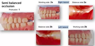 上頜架的注意事項