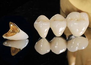 烤瓷牙修復(fù)后注意事項(xiàng)
