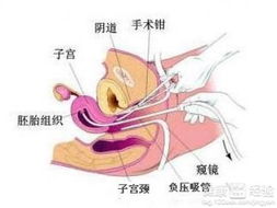 引產(chǎn),注意事項(xiàng),有哪些