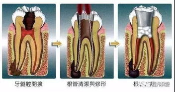 牙齒根充后的注意事項(xiàng)