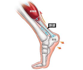 跟腱斷裂手術(shù)前后注意事項
