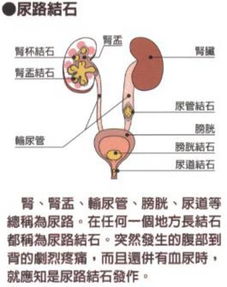 尿路結(jié)石術(shù)后注意事項(xiàng)