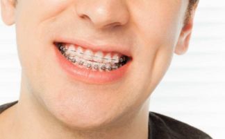 戴牙套的注意事項,戴牙套需要注意什么,剛戴牙套注意事項