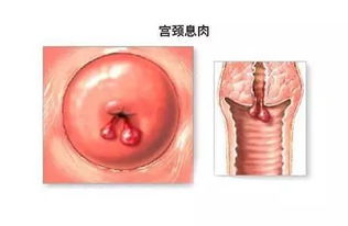 宮頸息肉注意事項,宮頸息肉治療后注意事項,宮頸息肉術(shù)后注意事項