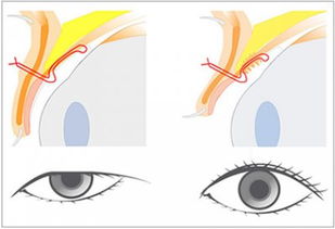 上瞼下垂手術拆線后注意事項,上瞼下垂矯正術后注意事項,上瞼下垂術后飲食注意事項