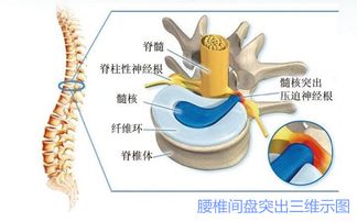 腰椎間盤突出癥患者注意事項(xiàng)有哪些呢?,腰椎間盤突出癥的注意事項(xiàng),腰椎間盤突出癥出院注意事項(xiàng)