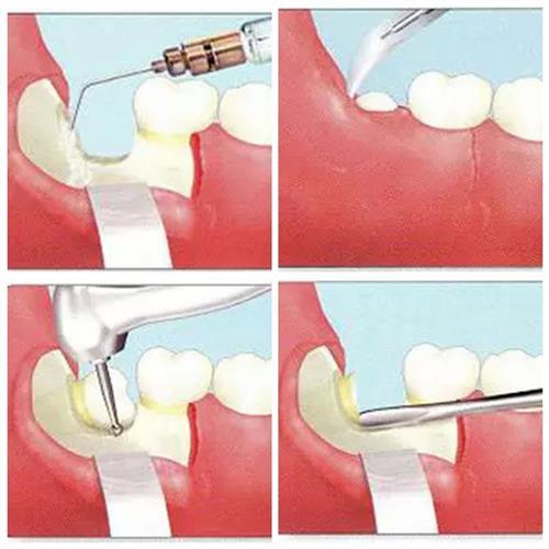 智齒,開刀,注意事項(xiàng)