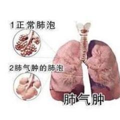 肺氣腫,應(yīng)注意,事項(xiàng)