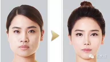 蛋白線面部提升注意事項